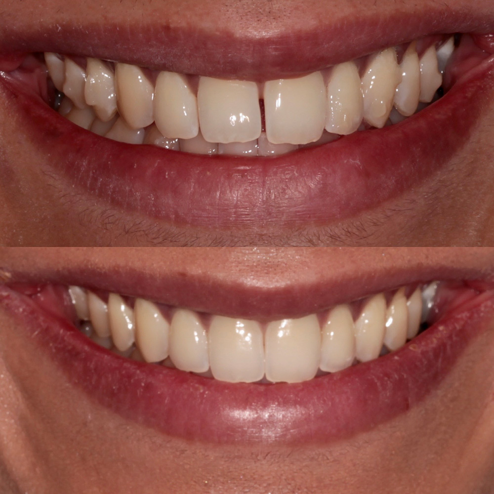 Composite bonding