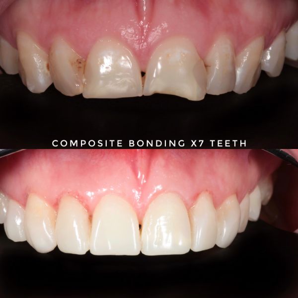 composite bonding